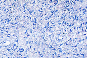 Image: Mycobacterium mucogenicum - Large histiocytes with clear cytoplasm and Fite acid-fast stain (Photo courtesy of Pathology Outlines).